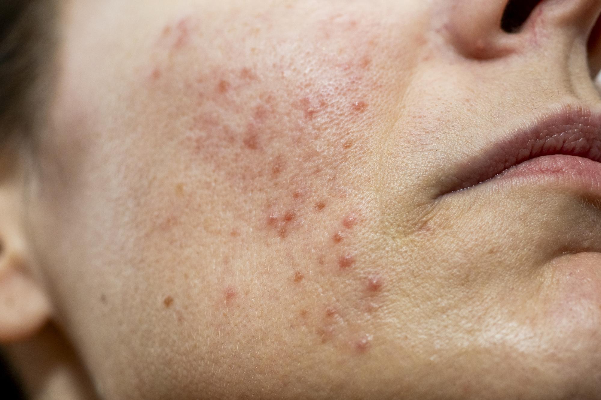 Akne u svakoj dobi uz uzroke i savjete dermatologa za pravilnu njegu