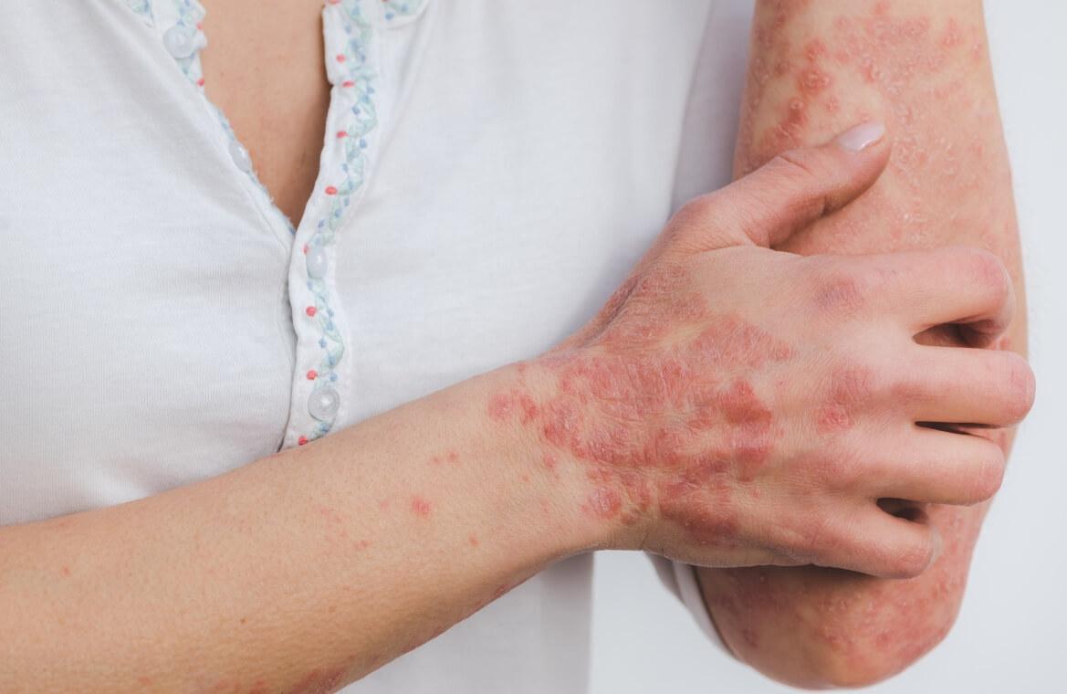 Psorijaza i atopijski dermatitis u fokusu njege i razumijevanja